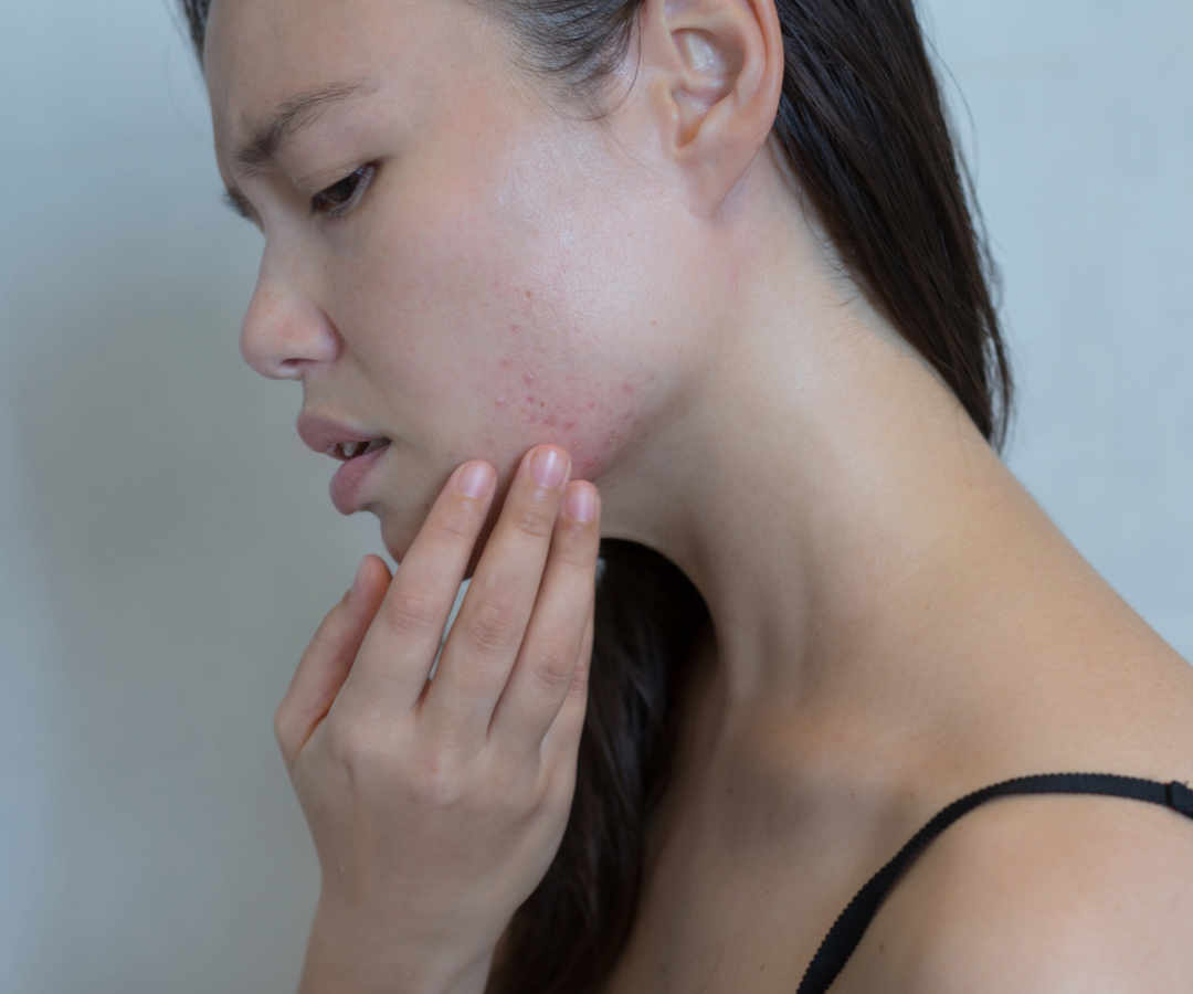 How to prevent those tiny skin coloured bumps?